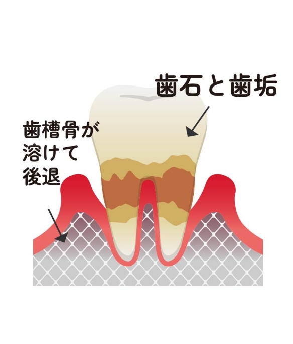 中等度歯周炎